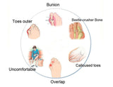 Orthopaedic Toe Bunion Corrector Pain Relief Day & Night Splinter